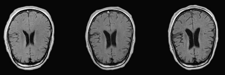 BRAIN ATROPHY OVER TIME Co-registered images acquired