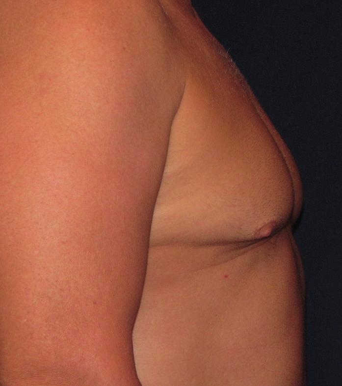 SURGICAL TREATMENT OF GYNAECOMASTIA There are three main surgical procedures which can be undertaken: Liposuction Liposuction is used to remove the fatty tissue under a general anaesthetic.