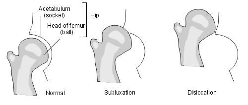 2018 Updates Chapter 19 Injury, poisoning and certain other consequences of external causes (S00-T88) Revisions From S73.03 Other anterior dislocation of hip To S73.