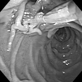 A pull-type sphincterotome was inserted into the major papilla, located in the lower margin of the perivater diverticulum, (B).