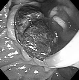 With a Dormia basket, two stones were retrieved through the dilated orifice of major papilla, (E). ERC after complete stone retrieval revealed no residual filling defect in the bile duct, (F).
