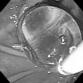 through a nasobiliary drainage catheter. Outcome measures The primary endpoint was the success rate of complete removal of stones with the initial ERCP session.