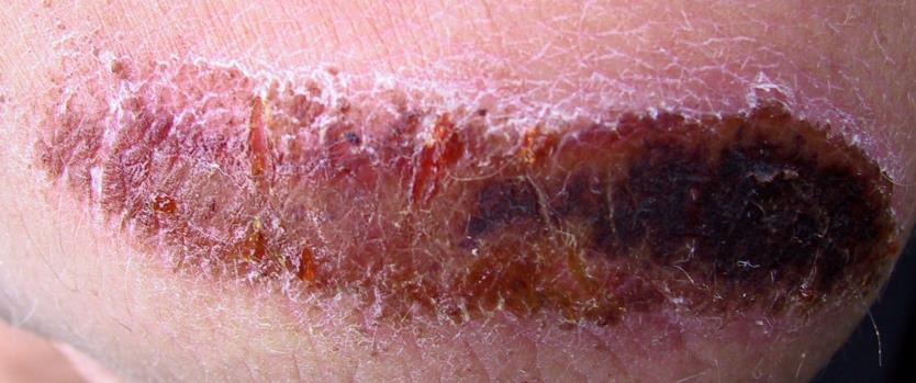 SCABS & ESCHAR Scabs & eschar are different both physically & chemically. Eschar is a collection of dead tissue within the wound that is flush with the surface of the wound.