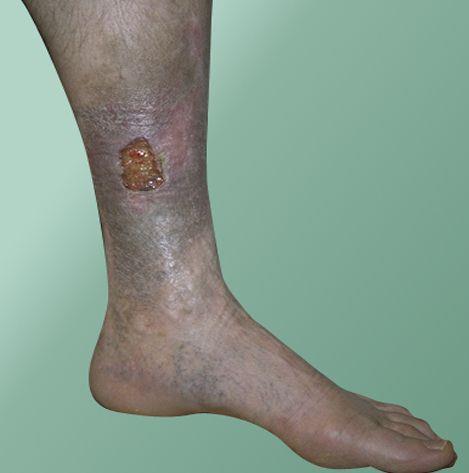 VENOUS AND ARTERIAL ULCERS VENOUS ULCERS Ulcers caused by peripheral venous disease, which most commonly occur proximal to the medial or lateral malleolus, above the inner or outer ankle, or on the
