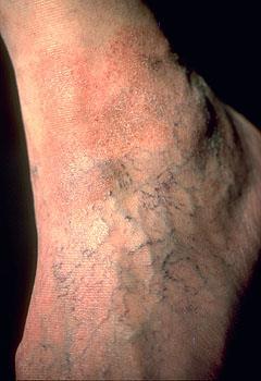 (Hemosiderin) Chronic stasis dermatitis Increased