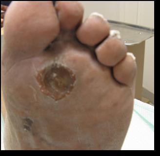 Diabetic Neuropathic Ulcer Characteristically occurs on the foot e.g.