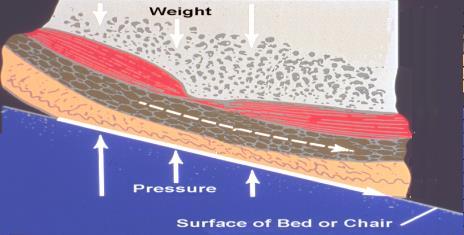 The pressure ulcer/injury can present as intact skin or an