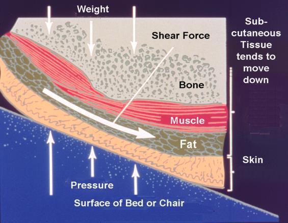 SHEAR Tissue layers slide against each other, disrupts or angulates blood vessels PLANNING FOR CARE The pressure ulcer/injury definitions used in the RAI Manual have been adapted from those