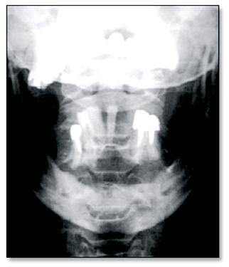 19 An American study reported the patterns of maxillofacial lesions resulting from horse related accidents.