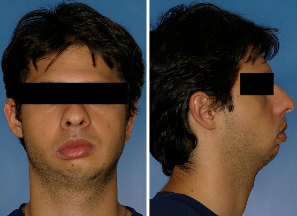 Figure 1. Patient in frontal and lateral view in the initial consultation.