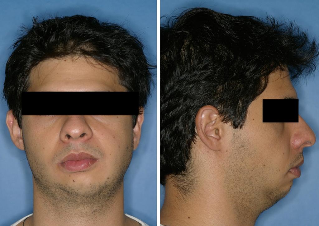 Figure 3. Patient in frontal and lateral view 7 months after the first bimaxillary orthognatic surgery.