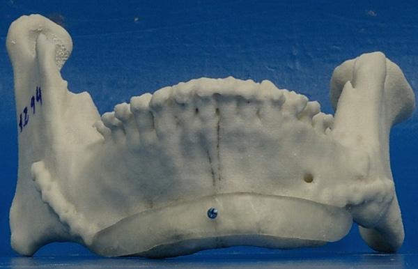 Stereolithographic Biomodel of jaw used to create a surgical cutting guide stabilized with 2.0 system 12 mm screw; the horizontal cut is made under the mental foramen of the right sector.