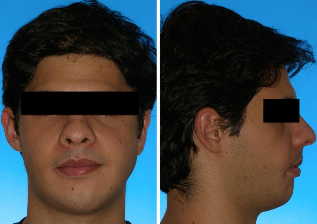 Figure 11. Patient in frontal and lateral view in post-operative stage 6 months after the second surgery.