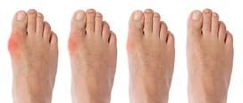 Pain Redness Bursa Footwear problem Clinical presentation Investigation Non