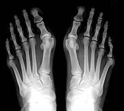 Mortons Neuroma Morton's neuroma is a painful foot condition that affects one of