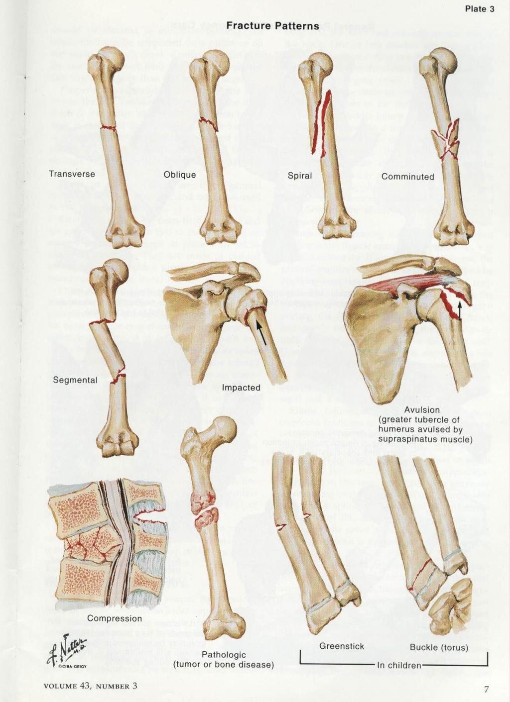 Dec 2 9:14 AM VIII. Bone Fracture & Repair B. Treatment: 1. Reduction: The realignment of bone ends. Closed: Open: 2. Immobilization: Cast or Splint C. Repair Process: 1.