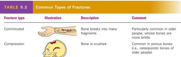 Common Types of Fractures Table 5.