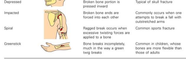 formed Break is splinted by fibrocartilage to form a callus