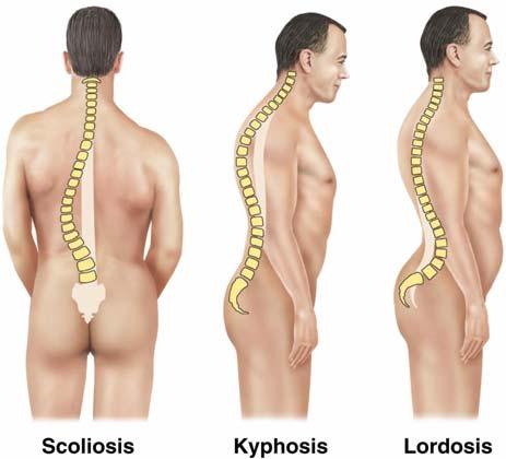 The Vertebral Column The spine has a normal curvature Primary curvatures are the spinal curvatures of the thoracic and sacral regions Present