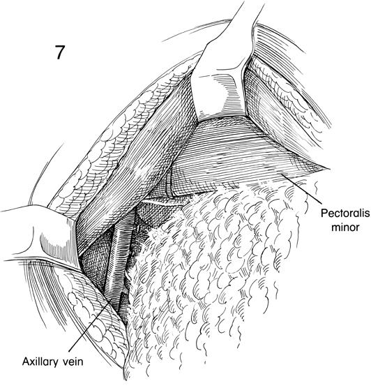 Procedures of ALND (I) Identification of landmark -> pectoralis muscles, LD Opening of clavipectoral fascia Preservation of