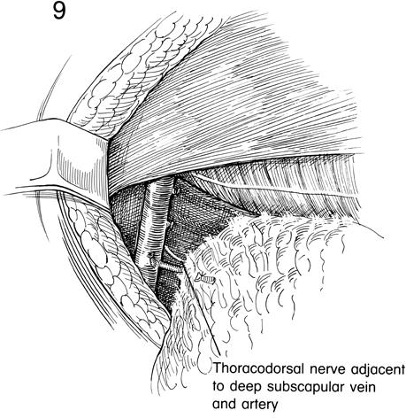 intercostobrachial nerve Identification of