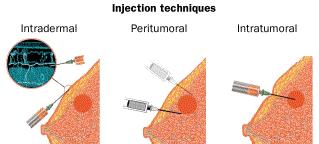 Lymphatic mapping Injection site Intradermal,