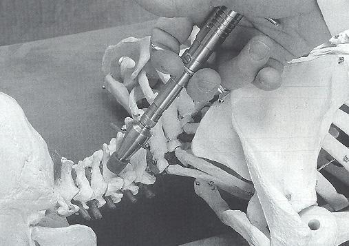 C5 Adjustment Contact Point : Pedicle lamina junction on the side of involvement