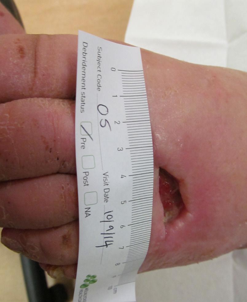 4 cm Week 8: Wound healed CASE 2 Exufber was used to treat a 4 month old diabetic foot ulcer, in a 68 year old patient.