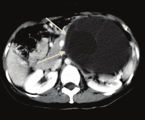 126 THAI J GASTROENTEROL 2016 Imaging of The Pancrease Axial view of CT and MRI shows a well-defined, lobulated contour, hypervascular mass at the pancreatic body containing a small central scar (red