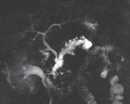 A 67-year-old man presenting with abdominal pain. Axial T1, coronal T2, and axial post contrast T1 of MRI show a complexed solid/cystic mass of the pancreatic head without pancreatic duct dilatation.