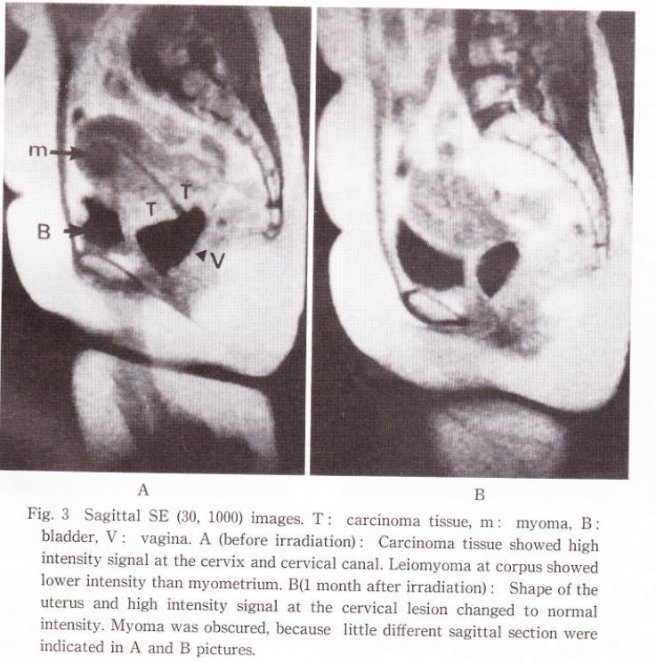 Clinical evaluation of MRI applied to brachytherapy for Cervical cancer Nakano T.
