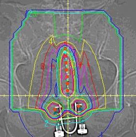 CT/MRI Based Planning