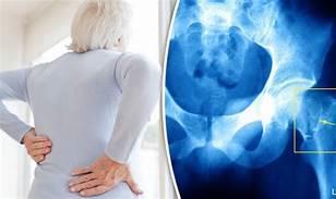 Age and Fracture Falls more common as we advance in age Many osteoporosis related fractures