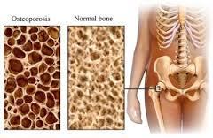 What is Osteoporosis Osteoporosis is a silent skeletal disease Low bone