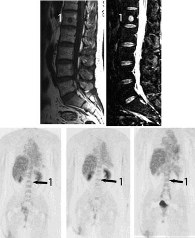 Spinal Metastasis from Myxoid Lipsarcoma/Schwab et al. 1819 although they all had positive MRI studies (Figure 2).