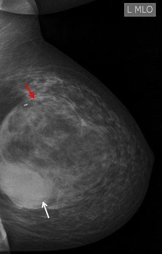 Figure 3: 55 year old female with a lump in the left breast. TECHNIQUE: Panoramic ultrasound with image magnification factor of 1.