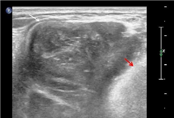 TECHNIQUE: Ultrasound with image magnification factor of 1.