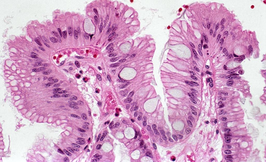 Diagnosis of Barrett Esophagus Often a hybrid epithelium with gastric foveolar cells