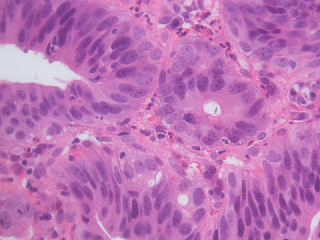 Barrett Esophagus with High-grade Dysplasia