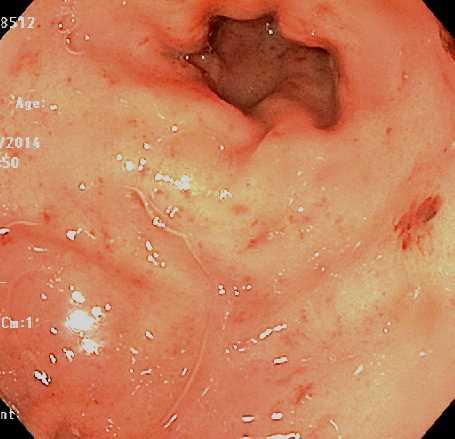 Infectious Esophagitis A 56 year-old man who recently underwent stem cell