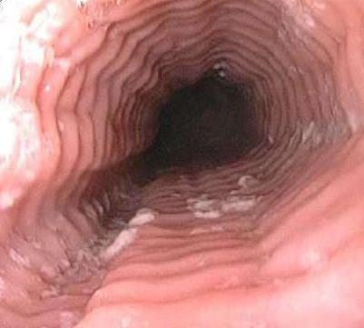 Esophagitis A 30 year-old man with history