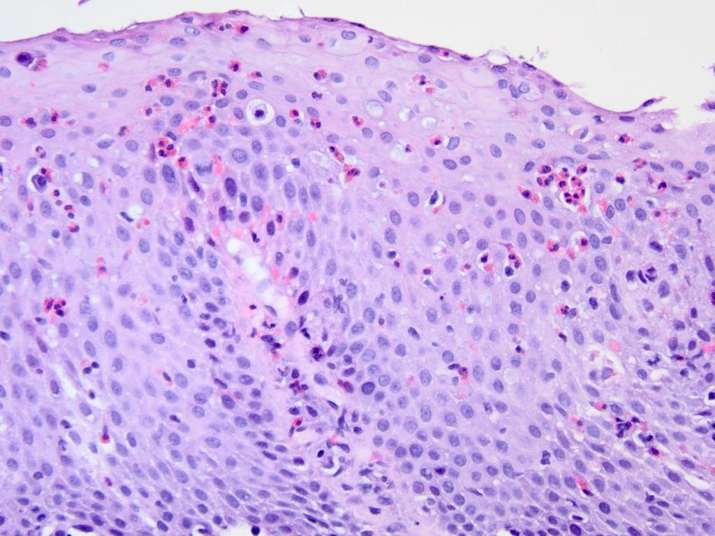 Esophageal Biopsy Lots of eosinophils with eosinophil microabscesses (circles) Luminal