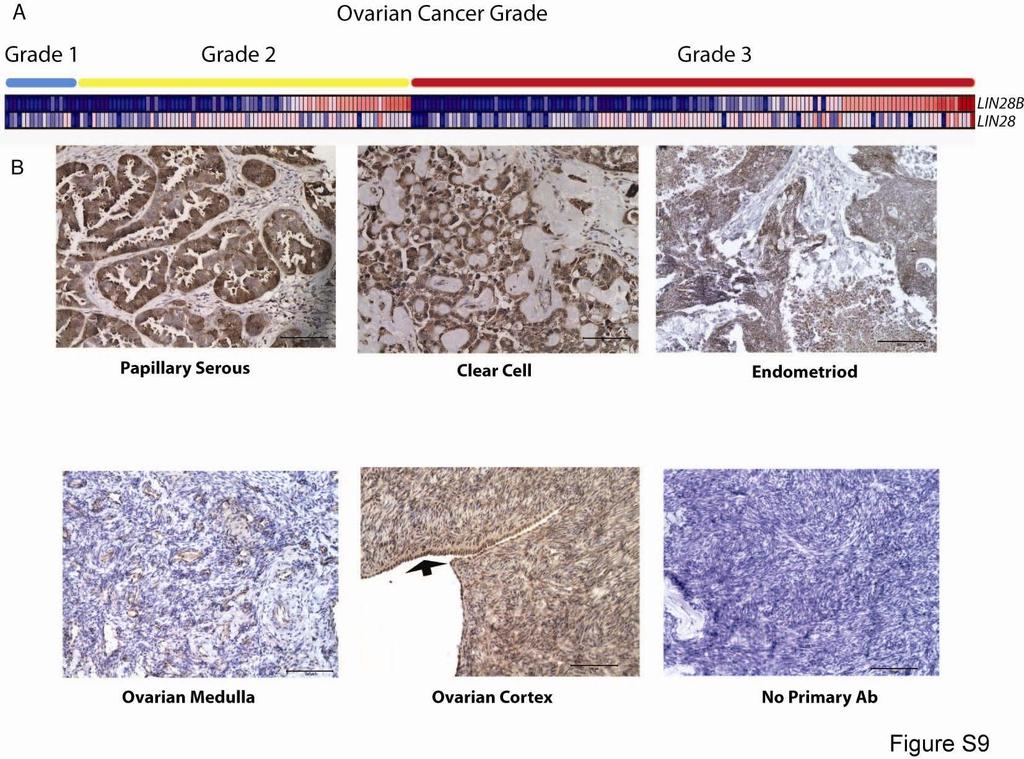 Figure S9. LIN28/LIN28B expression in Ovarian Cancer. (A) LIN28/LIN28B expression in a panel of ovarian tumors as determined by microarray analysis and grouped by histological grade.