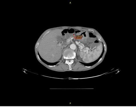 Fig. 2. CT-scan: Perilesional adenopathy. On admission, laboratory findings revealed mild anemia (Hb = 11 g/dl) with tumor markers within normal range.