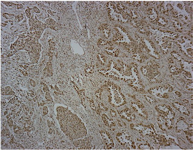 Estrogen receptor β in lung adenocarcinoma mixed bronchioloalveolar, solid, signet ring, mucinous, clear cell).