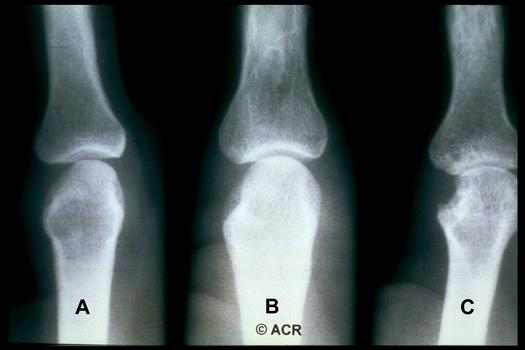 Improving Outcomes in RA: Three Pillars RA: Chronic Joint