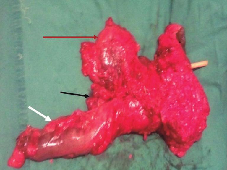 Journal of Gastrointestinal Oncology Vol 7, No 3 June 2016 347 Figure 2 Exenteration specimen showing rectum (white arrow), urinary bladder (red arrow), and seminal vesicle (black arrow).