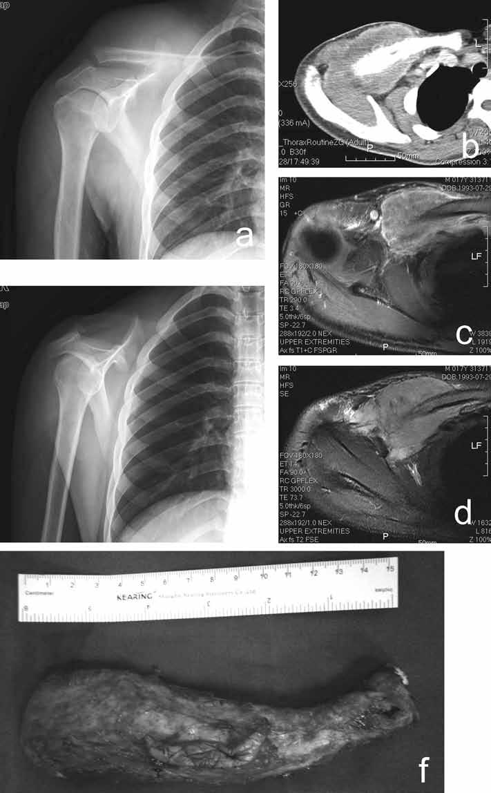 172 Z. Li, Z. YE, M. ZHAng e Fig. 1a-f. Eighteen-year-old male with PnET in the lateral third of the right clavicle.