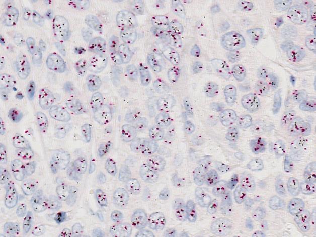 1b (x400) Ventana/Roche, of the breast carcinoma no. 2 without HER2 gene amplification: HER2/chr17 ratio > 1.0-1.2*. The HER2 genes are stained black and chr17 red.
