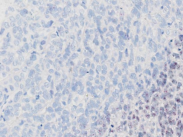 Fig. 5a (x200) Insufficient staining for the HER2 gene using the INFORM Dual ISH kit cat. no. 800-4422, Ventana/Roche, of the breast carcinoma no. 2 without gene amplification: HER2/chr17 ratio > 1.